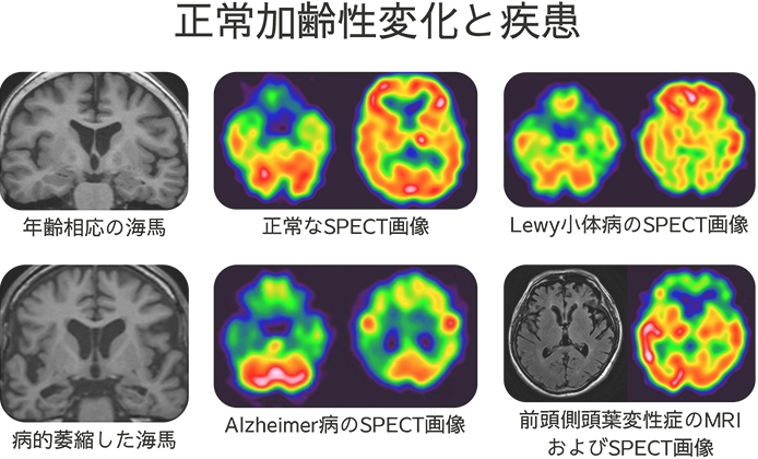正常加齢性変化と疾患